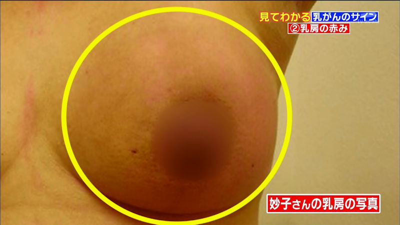 乳がん検診 おっぱい チェック TV キャプ エロ画像【6】