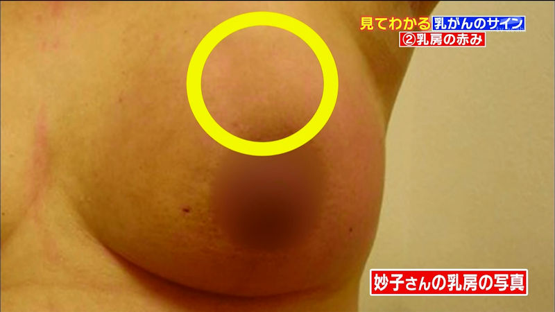 乳がん検診 おっぱい チェック TV キャプ エロ画像【7】