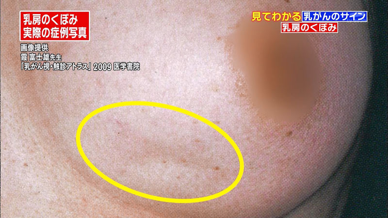 乳がん検診 おっぱい チェック TV キャプ エロ画像【11】
