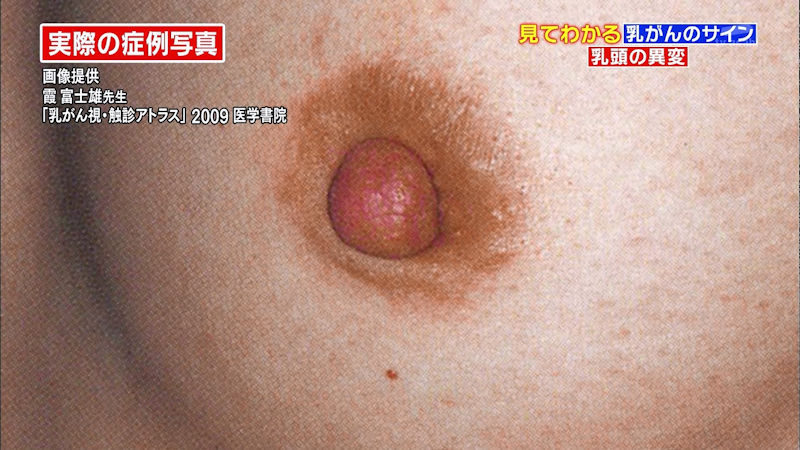 乳がん検診 おっぱい チェック TV キャプ エロ画像【12】